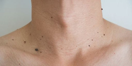 Vad är skin tags?